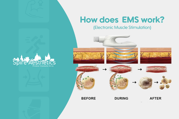 EMS treatment for post pregnancy weight loss treatment Walsall