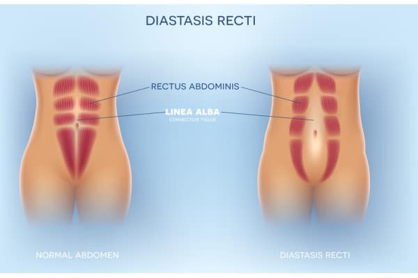 What Non-Surgical Options Are Available for Diastasis Recti Walsall?