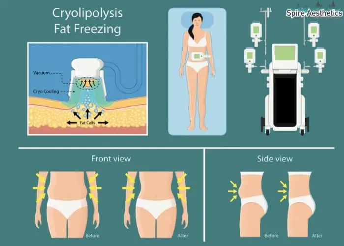 Fat freezing treatment Walsall benefits for competitions to remove stubborn fat deposits.